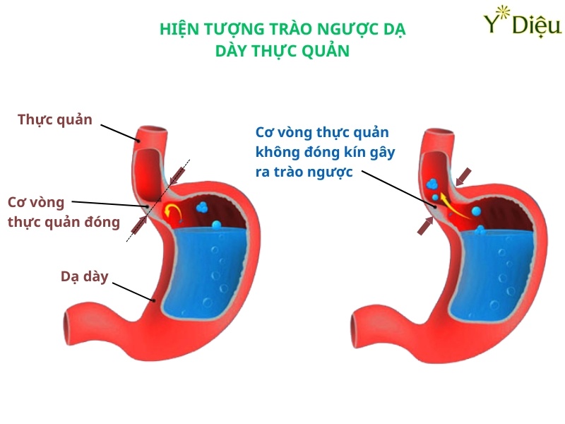 Mô phỏng triệu chứng trào ngược dạ dày thực quản